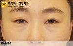 eye surgery