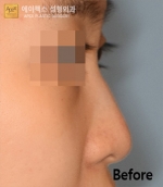 Rhinoplasty