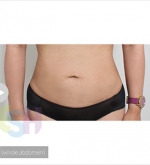 Liposuction