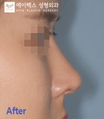 Rhinoplasty