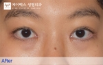 eye surgery