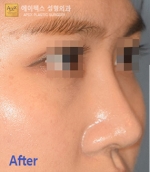 Rhinoplasty