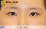 eye surgery