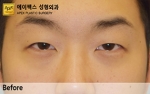 eye surgery