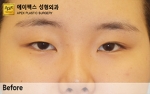 eye surgery