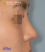 Rhinoplasty