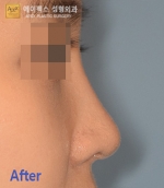 Rhinoplasty