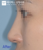 Rhinoplasty