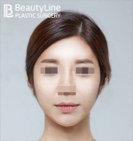 Beauty Line Plastic Surgery,Reviews,Images, Promotions — Korea cost, reviews & before-after | MISOODA
