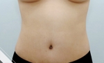 Glovi Plastic Surgery, Reviews, Images, Promotions, Dr. Rho Bongil, Dr. Nam Sangjae, Dr. Park Jongchul — Korea cost, reviews & before-after | MISOODA