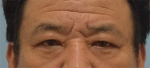face lift