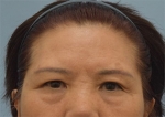 face lift