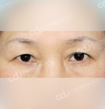 eye surgery