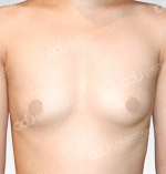 breast