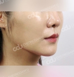face lift