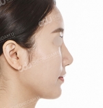 face lift
