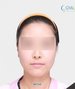 GYALUMHAN Plastic Surgery,Reviews,Images, Promotions — Korea cost, reviews & before-after | MISOODA