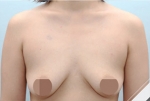 Glovi Plastic Surgery, Reviews, Images, Promotions, Dr. Rho Bongil, Dr. Nam Sangjae, Dr. Park Jongchul — Korea cost, reviews & before-after | MISOODA
