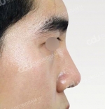 Rhinoplasty