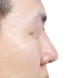 Rhinoplasty