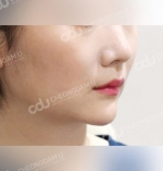 facial contouring