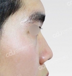 Rhinoplasty