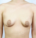 breast