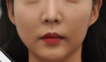 Glovi Plastic Surgery, Reviews, Images, Promotions, Dr. Rho Bongil, Dr. Nam Sangjae, Dr. Park Jongchul — Korea cost, reviews & before-after | MISOODA