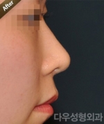 Rhinoplasty