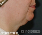 face lift