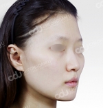 facial contouring