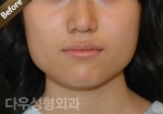 facial contouring