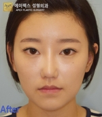face lift