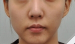 Glovi Plastic Surgery, Reviews, Images, Promotions, Dr. Rho Bongil, Dr. Nam Sangjae, Dr. Park Jongchul — Korea cost, reviews & before-after | MISOODA