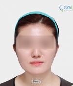 GYALUMHAN Plastic Surgery,Reviews,Images, Promotions — Korea cost, reviews & before-after | MISOODA