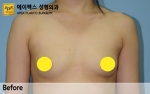 breast
