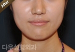 facial contouring