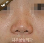 Rhinoplasty