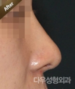 Rhinoplasty