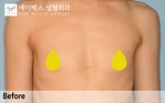 breast