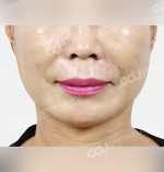 face lift