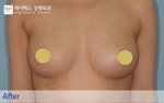 breast