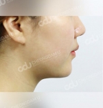 facial contouring