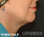 face lift