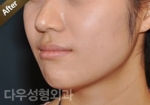 facial contouring