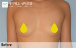 breast