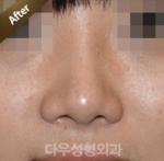 Rhinoplasty