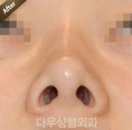 Rhinoplasty