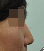 Glovi Plastic Surgery, Reviews, Images, Promotions, Dr. Rho Bongil, Dr. Nam Sangjae, Dr. Park Jongchul — Korea cost, reviews & before-after | MISOODA