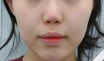 Glovi Plastic Surgery, Reviews, Images, Promotions, Dr. Rho Bongil, Dr. Nam Sangjae, Dr. Park Jongchul — Korea cost, reviews & before-after | MISOODA